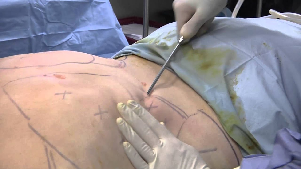 Best Liposuction Procedure